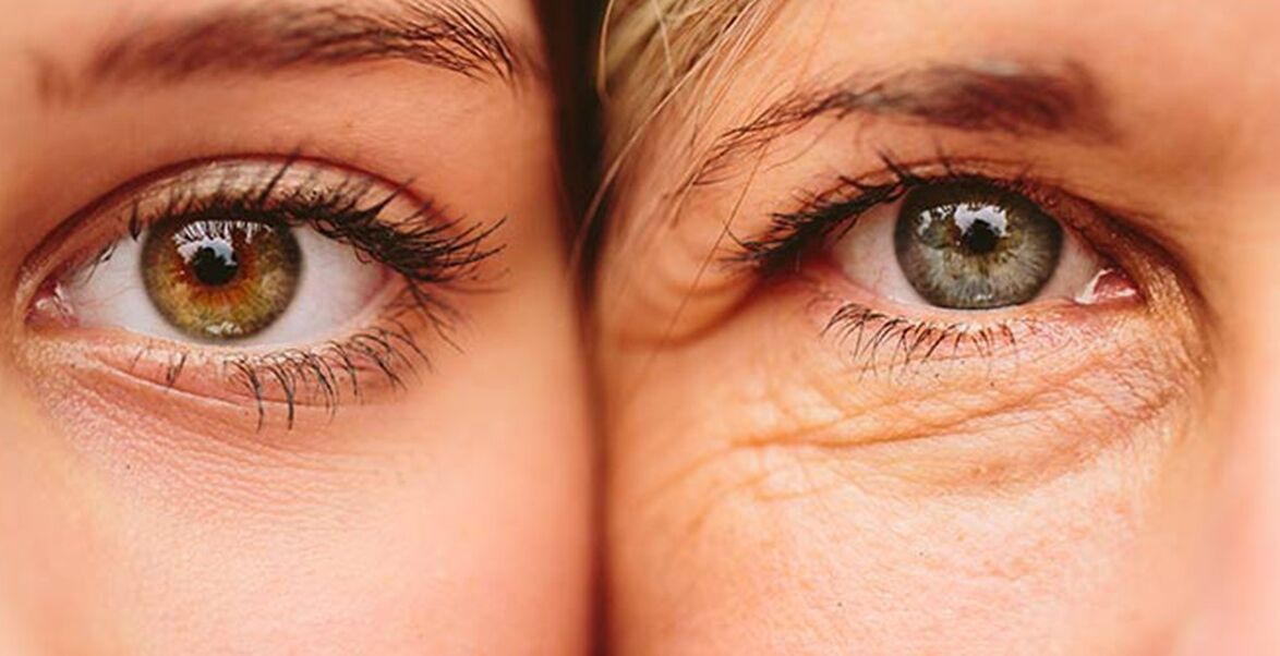 Farklı yaşlardaki iki kadında göz çevresinde cilt yaşlanmasının dış belirtileri