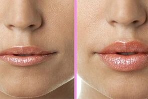 dudak restorasyonundan önce ve sonra
